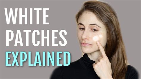 White Patches On The Face Explained Pityriasis Alba Dr Dray White