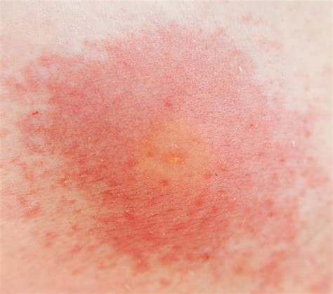 Pictures Of Skin Rashes Lovetoknow Health And Wellness Types Of Bug