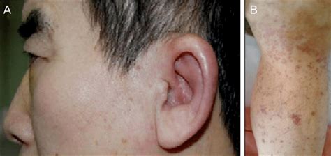 A Photograph Shows Erythematous Swelling Of The Left Auricle