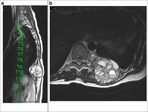 Aneurysmal Bone Cyst Of The Thoracic Spine And Rib A Mri Thoracic