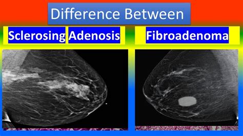 Difference Between Sclerosing Adenosis And Fibroadenoma Youtube