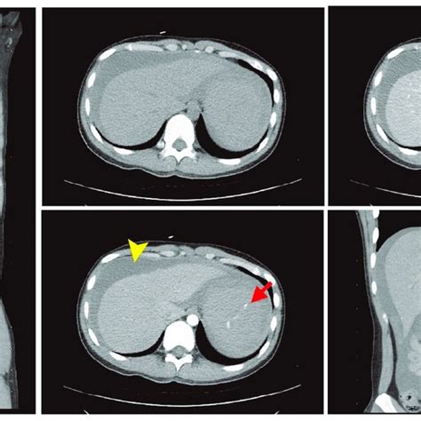 The Abdominal Contrast Enhanced Computed Tomography Ct Showed