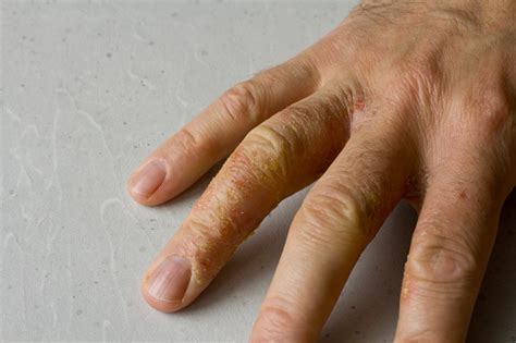 Primo Piano Di Eczema Dermatitis Sulla Mano E Sulle Dita Delluomo