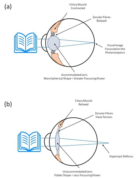 Figure 7 The Effect Of Ciliary Muscle Webvision Ncbi Bookshelf