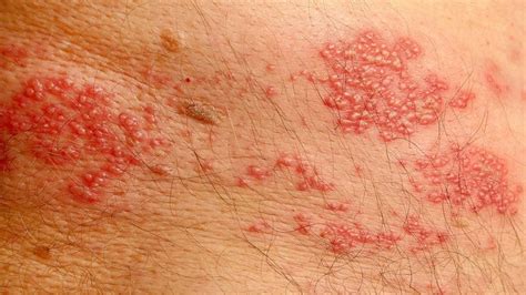8 Common Types Of Rashes And What They Look Like