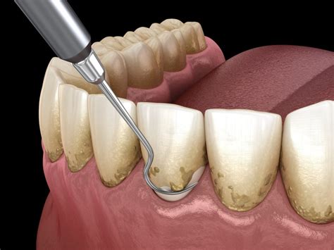 Gum Disease Periodontal Treatment Nashoba Family Dentists