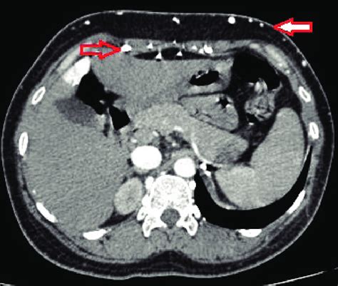 Axial Contrast Enhanced Ct Image Showing Multiple Anterior Abdominal