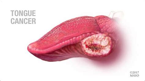 Tongue Cancer Maritza O Jenkins Dmd General Dentist