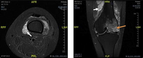 Mri Of The Right Knee Joint Revealed Arthritis With Synovial