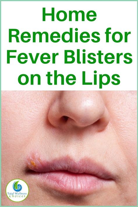 13 Natural Home Remedies For Fever Blisters On The Lips Home Remedies