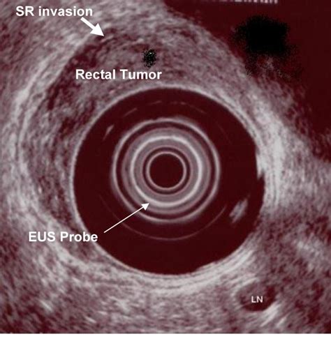 The Role Of Endoscopic Ultrasound In The Evaluation Of Rectal Cancer