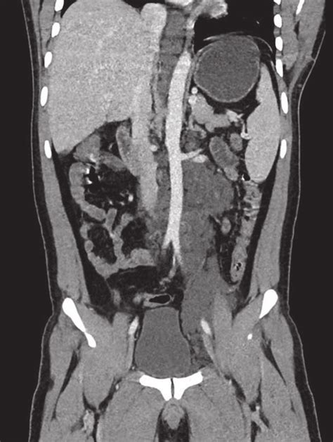 Abdomen Contrast Enhanced Computed Tomography Image With Curved