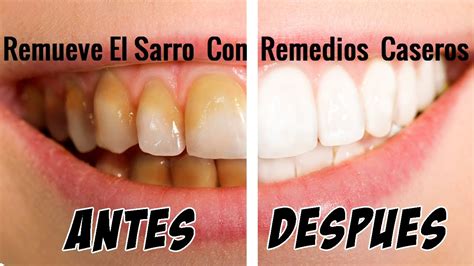 Remover El Sarro De Tus Dientes Con 3 Remedios Caseros Youtube