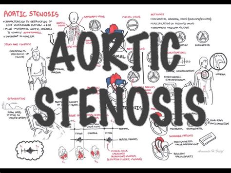 Aortic Stenosis Overview Signs And Symptoms Pathophysiology Treatment Medical Source