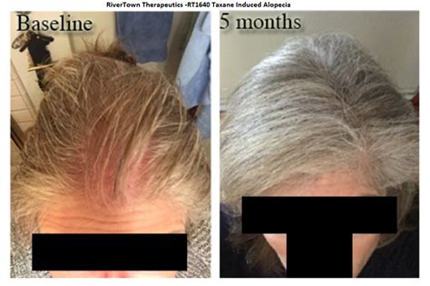 Chemotherapy Induced Alopecia Follicle Thought