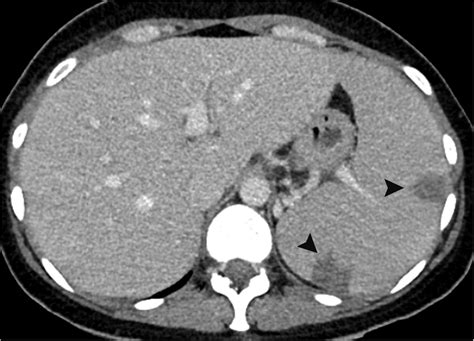 Contrast Enhanced Abdominal Ct Scan Transverse View Venous Phase