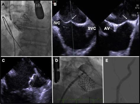 Left Atrial Appendage Occlusion For Patients With Transcatheter Aortic