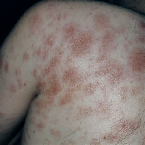Dry Itchy Red Flaky Skin Bumps Rdermatologyquestions