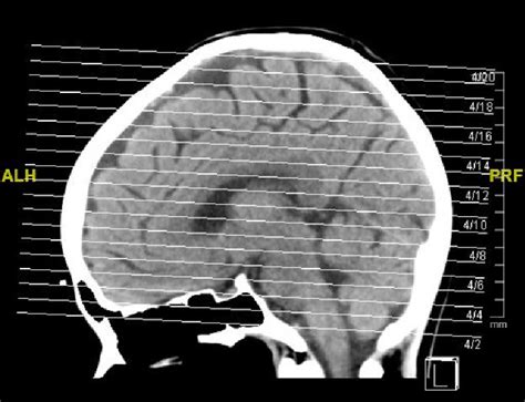 Ct Scan Shows Frontal Brain Atrophy Download Scientific Diagram