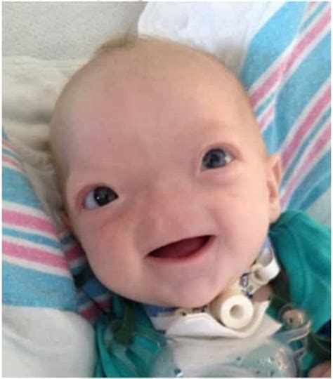 Dieses Baby wurde ohne Nase geboren und ist total süß! 6 niedliche
