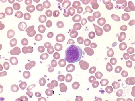 Myelofibrosis Peripheral Blood 4