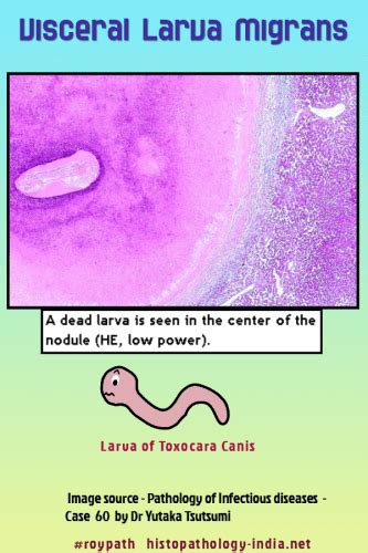 Pathology Of Visceral Larva Migrans Dr Sampurna Roy Md