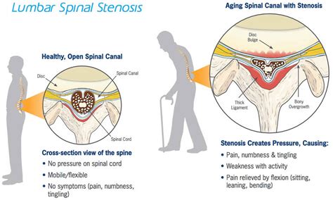 Spinal Stenosis Causes Symptoms Diagnosis Treatment And Exercises