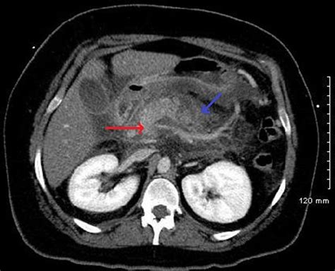 Ct Of The Abdomen Demonstrating Pancreatitis With Patchy Necrosis Red