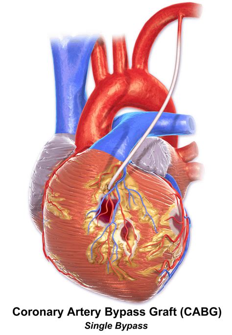 Coronary Artery Bypass Grafting Cabg Almostadoctor