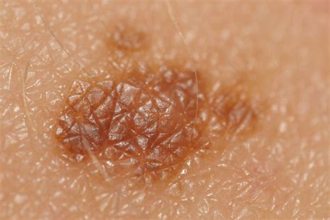 Skin Cancer Symptoms Diagnosis And Treatments Dermatology Boca