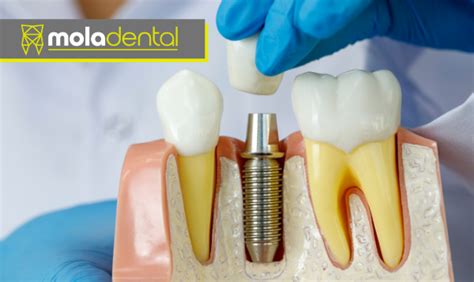 Dental Implants Your Questions Answered Mola Dental