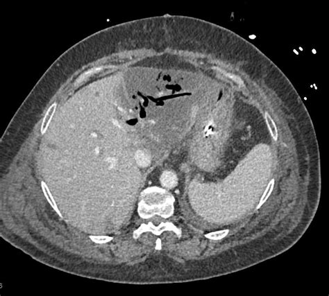 Liver Infarct With Left Lobe Abscess Liver Case Studies Ctisus Ct