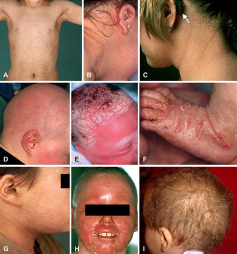 Clinical Examples Of Syndromic Forms Of Ichthyosis Trichothiodystrophy