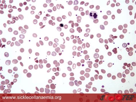 Sickle Cell Blood Smear Viv Caruna Flickr