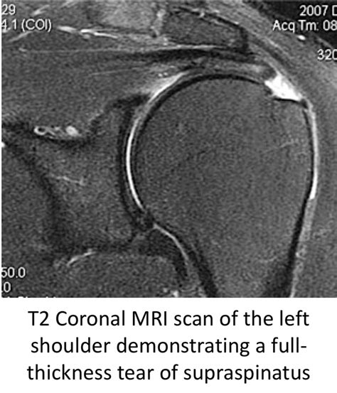 Fig 15 MRI Scan Cambridge Shoulder
