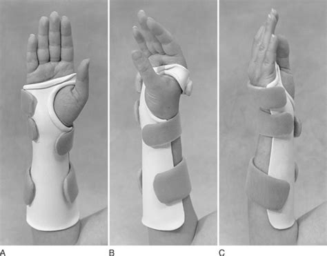 Splints Acting On The Wrist Musculoskeletal Key