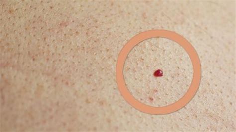 What Causes Red Moles On Your Skin