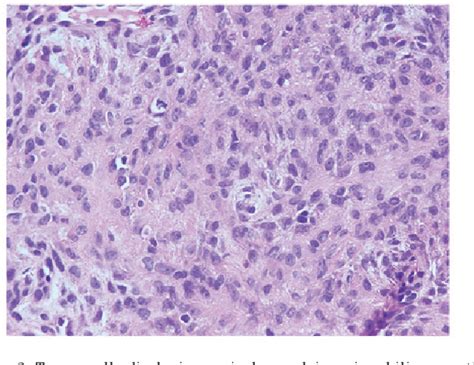 Figure 3 From Cutaneous Syncytial Myoepithelioma A Case Report With