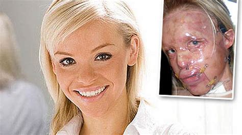 Katie Piper Before And After