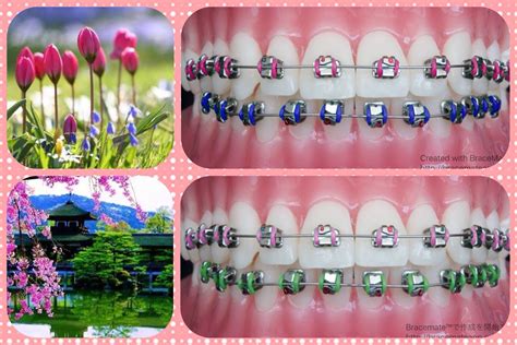 √ Color Ideas For Braces