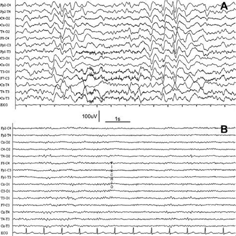 Eeg Recording Showing Frequent Triphasic Waves During Hyperammonemic