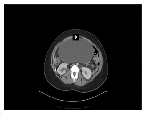 Abdominal Ct Scan Without Contrast Showing The Pelvic Tumor