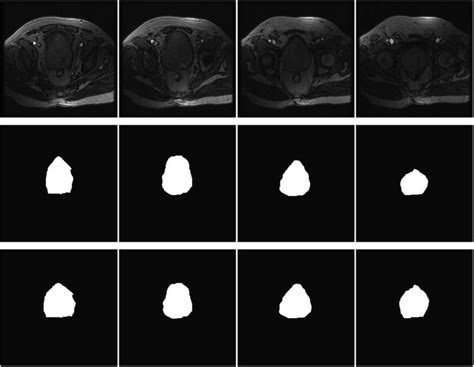 4 Forming Prostate Shape Prior Projected Onto 2d0020 Top Row Training