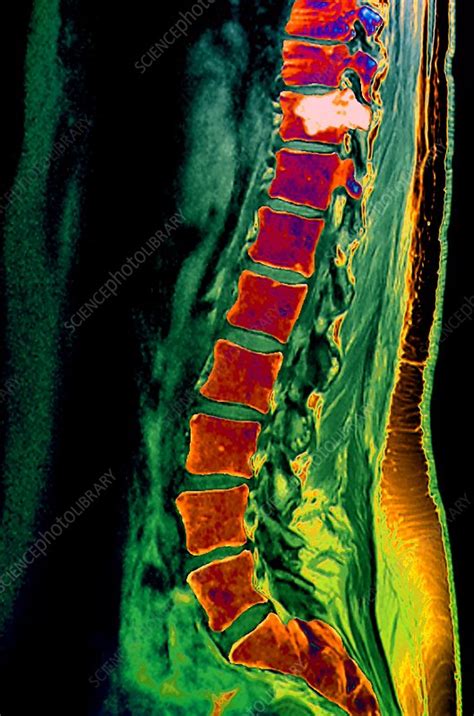 Bone Cancer Treatment Mri Scan Stock Image C0017360 Science