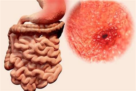 ¿la Gastritis Puede Causar Cáncer De Estómago Natursan