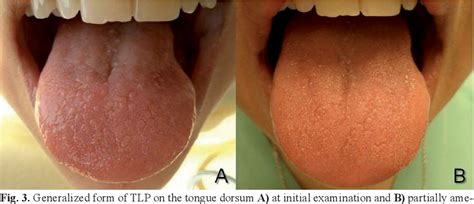 Figure 2 From Transient Lingual Papillitis A