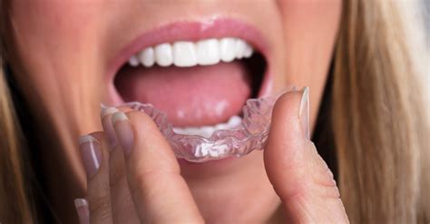 ways that a night guard can help with bruxism elevate dental wellness