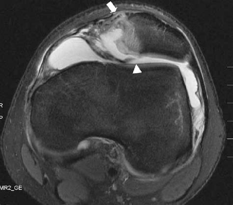 A Transverse T2 Weighted Fast Spin Echo Mri Of The Knee Obtained At
