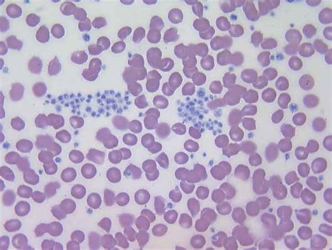 Platelets Overview Morphology Quantity Platelet Function Disorders