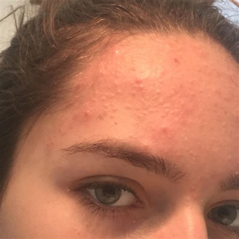 Tiny Bumps On Forehead Small Pimples Small Bumps On F
